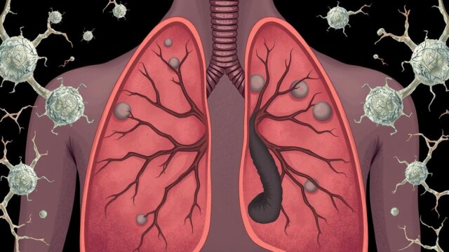 Understanding Mesothelioma: Causes and Treatment