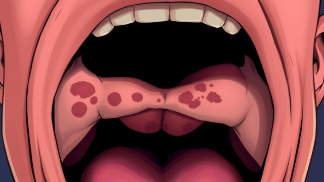 Understanding Mouth Cancer: Symptoms and Risks